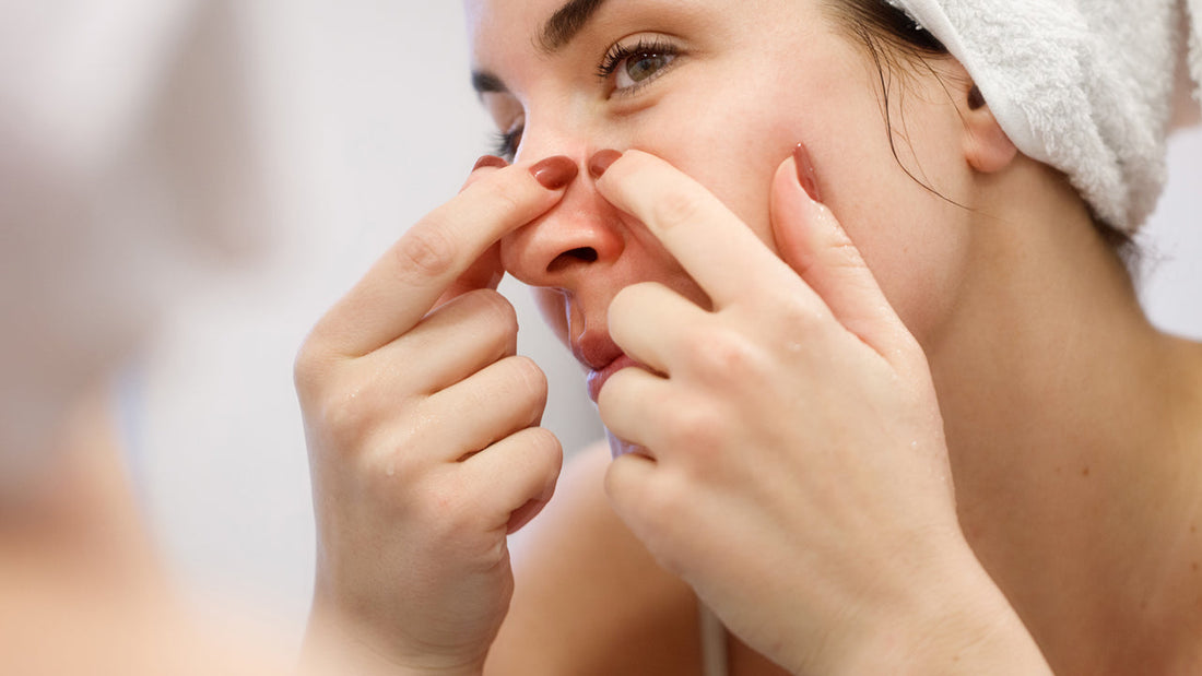 7 Herbal Remedies for Pimples That Actually Work