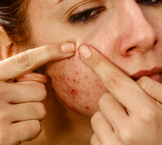 Acne & Breakouts