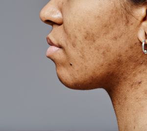 Uneven Skin Tone / Pigmentation