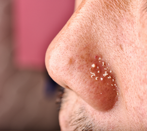 Oily Skin & Excess Sebum